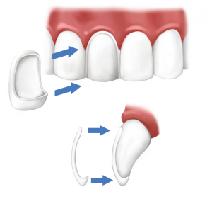 dental-veneers