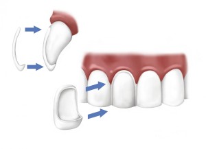 porcelain-veneers-beverly-hills